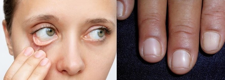 Pale Eyelids and Nails (Panduta)