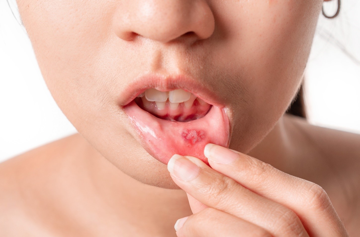 Stomatitis (Mouth Sores)