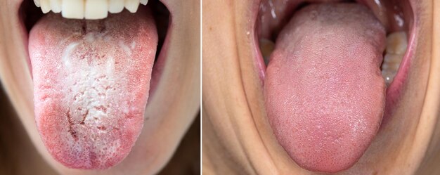 White Coating on Tongue (Shwetapaṭalika)