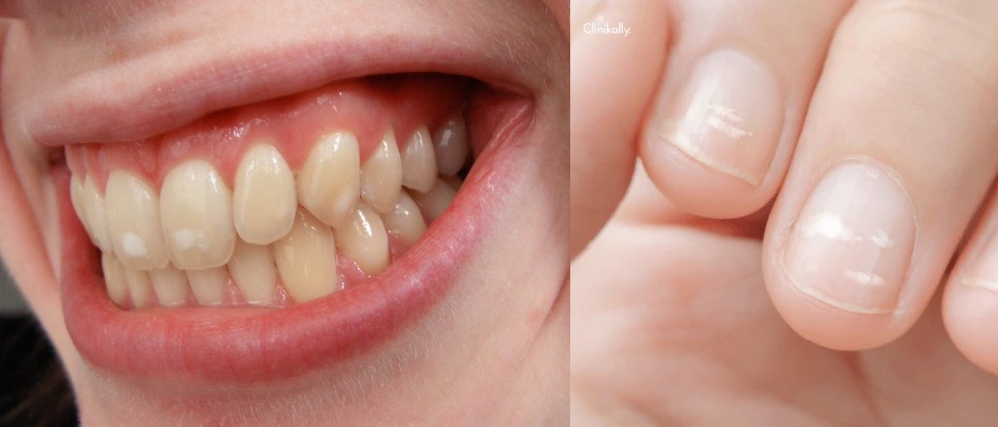 White Spots on Nails and Teeth