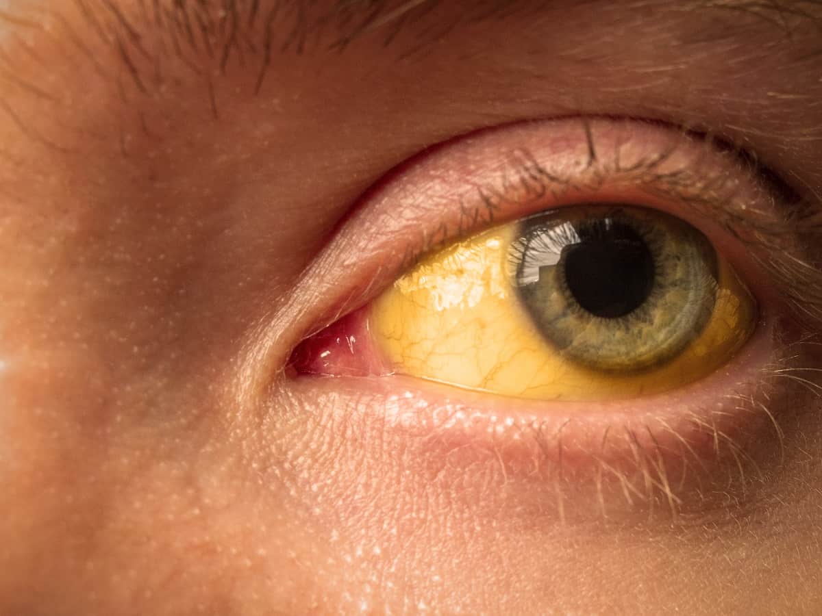 Yellowing of Skin or Eyes (Jaundice)