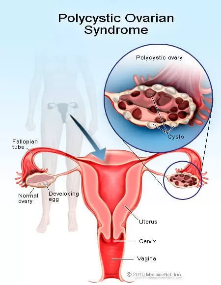 vyadhi_images/poly_cystic_ovarian_syndrome_pcos.webp